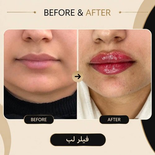 فیلر لب در عظیمیه کرج