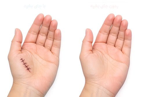 کربوکسی تراپی جای بخیه در کرج