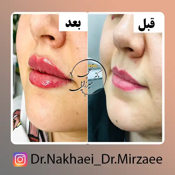 نمونه کار فیلر لب کلینیک دکتر نخعی