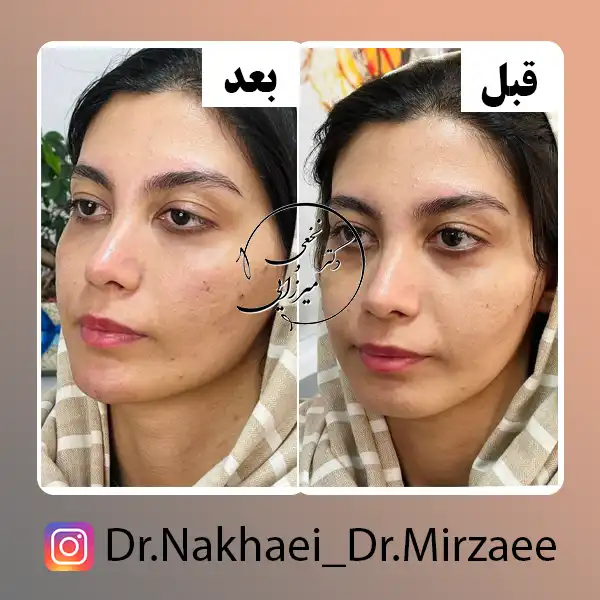 نمونه کار فیلر زیر چشم کلینیک دکتر نخعی