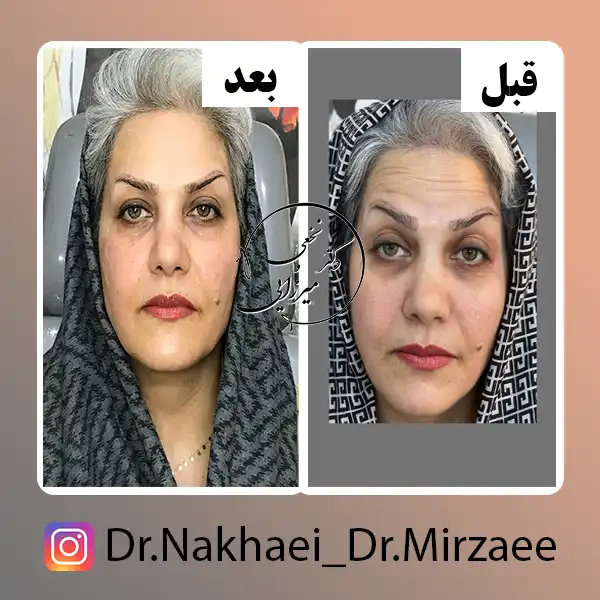 نمونه کار بوتاکس کلینیک دکتر نخعی