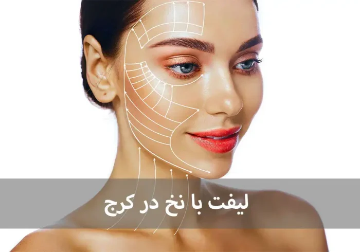 لیفت با نخ در کرج