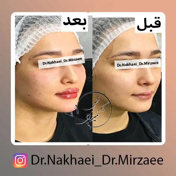 نمونه کار کانتورینگ صورت کلینیک دکتر نخعی