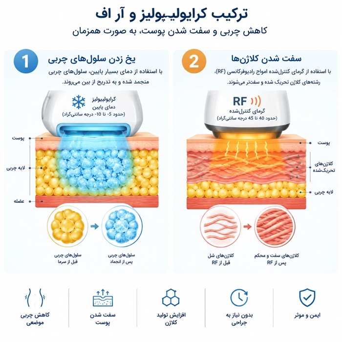 مکانیسم عملکرد لاغری با کرایولیپولیز و آر اف 